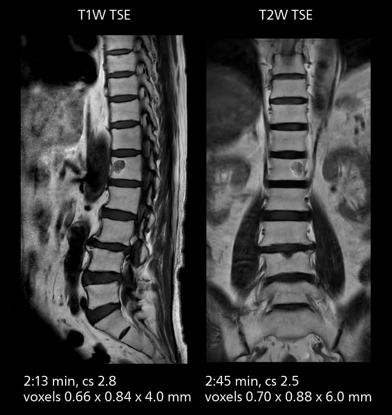 Lumbar spine mri two