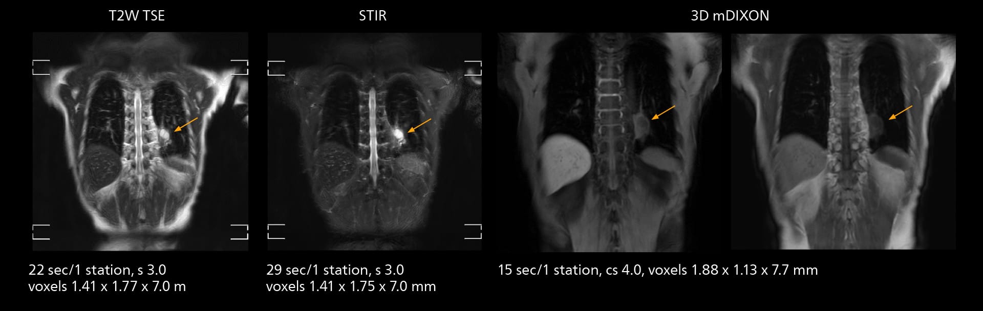 Whole body mri one